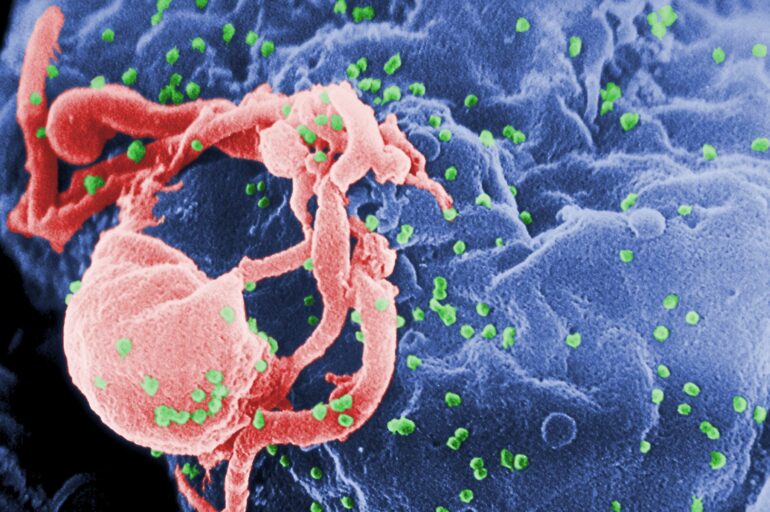 US researchers eliminate HIV infection