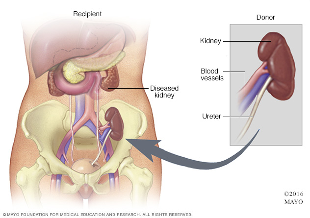 What happens when a transplanted kidney fails