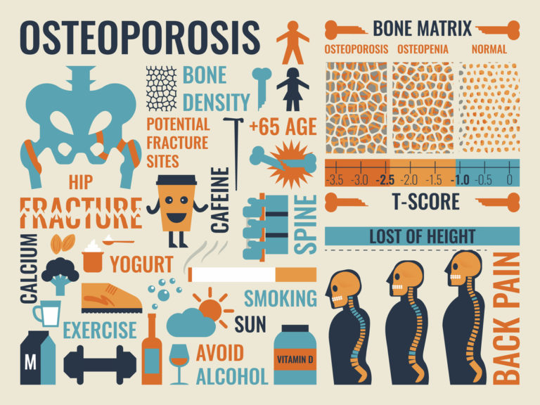 Osteoporosis Signs, Symptoms and Diet