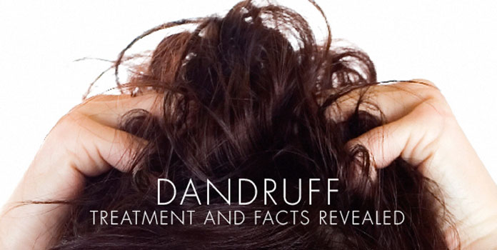 dandruff treatment cure